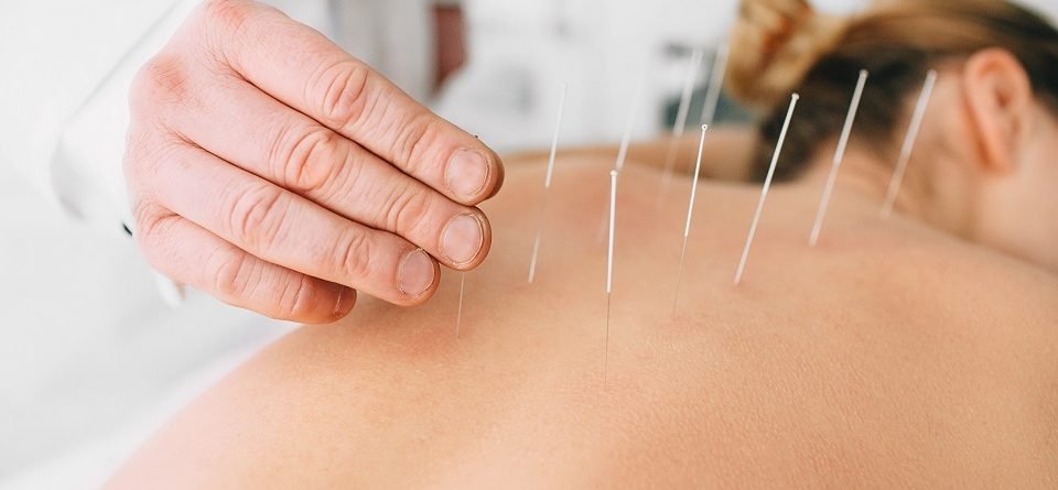 Acupuncture Therapy in Thane | Lifeshots Healthcare