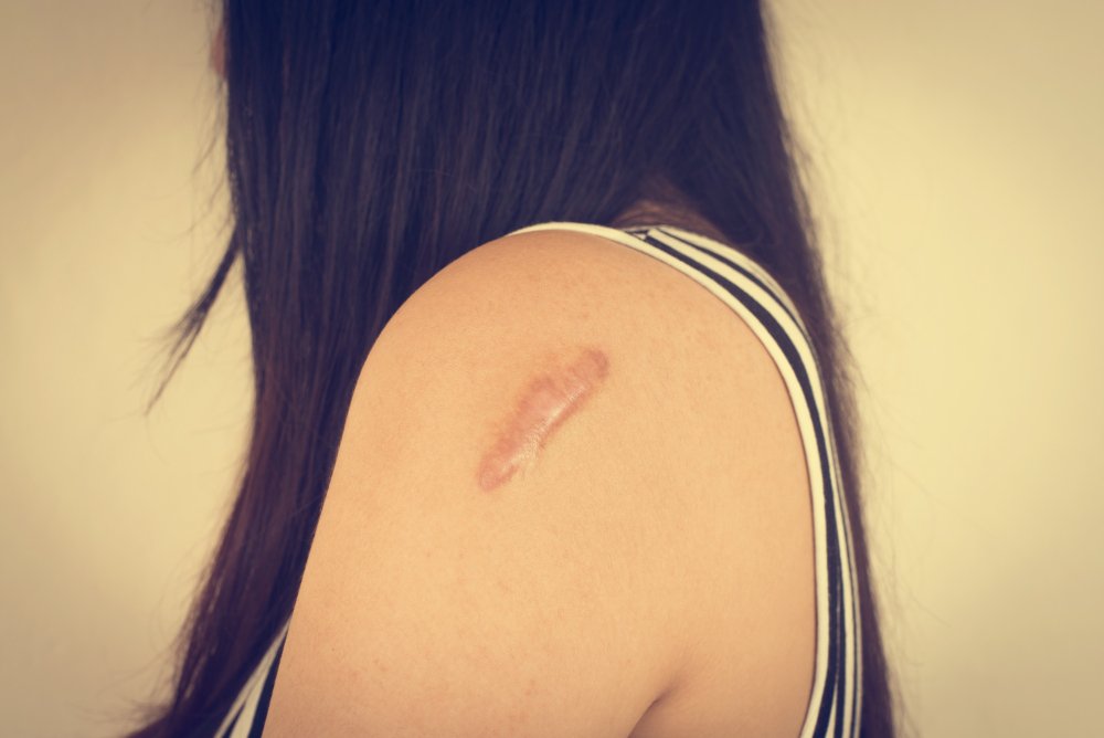 Advanced Scar Reduction Treatment at Lifeshots Healthcare in Hiranandani Estate, Thane